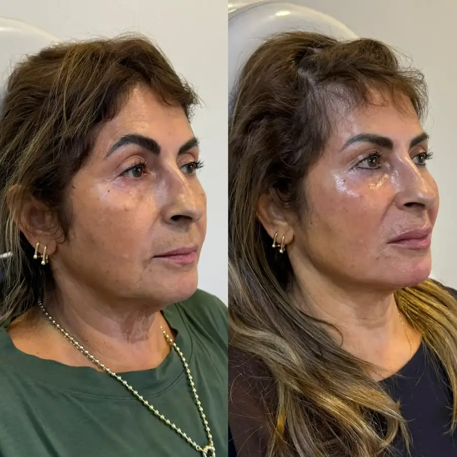 Aionê Lift Face