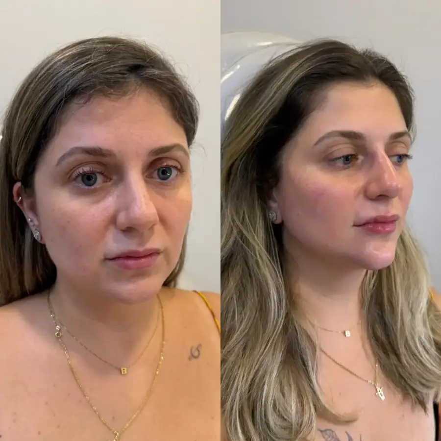 Antes e depois 5